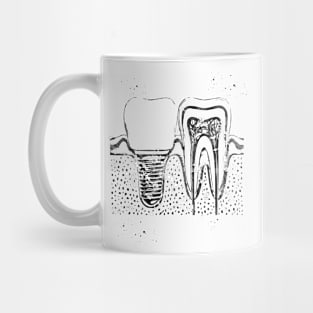 Human teeth and dental implant Mug